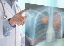 Doctor Reviewing Xray Of Lungs Damaged From Military Training