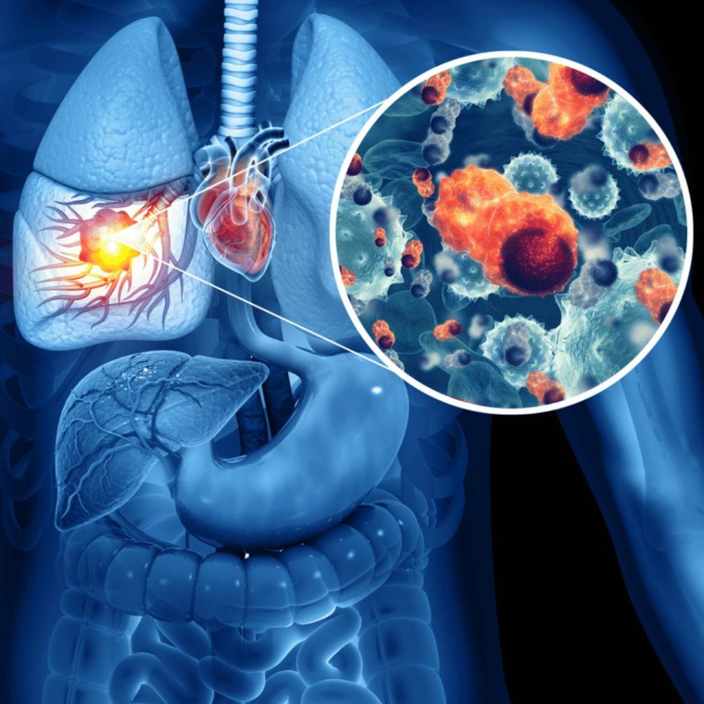 Lung Cancer Diagnosis After Bp Oil Spill Exposure For Clean-Up Workers